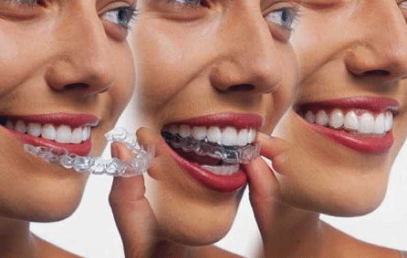 a girl wearing invisalign step by step