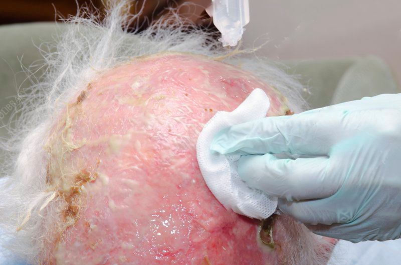 Hair fall after infected scalp