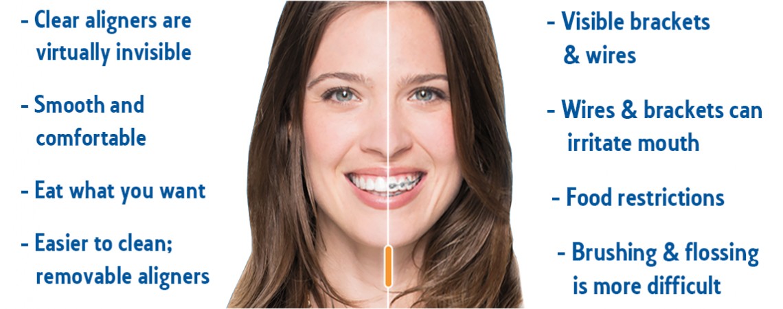 Traditional Braces vs Invisalign Brushing, Flossing, and Oral Hygiene