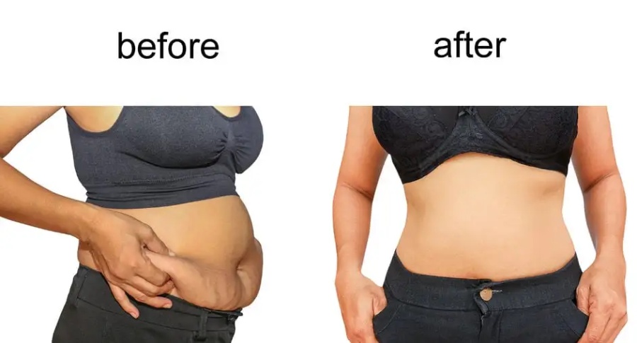 Coolsculpting vs. Liposuction