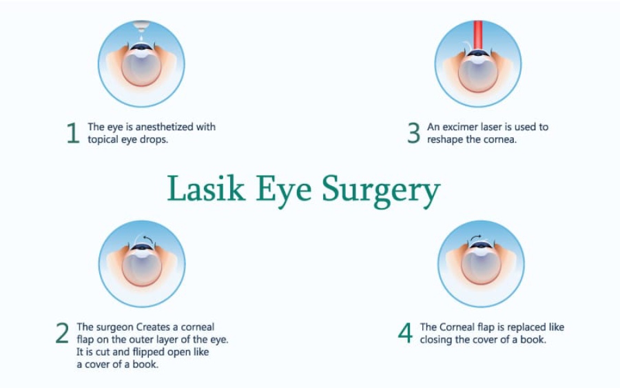 What is LASIK treatment