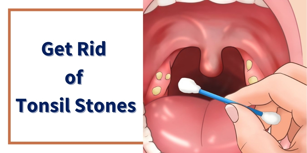 Get Rid of Tonsil Stones