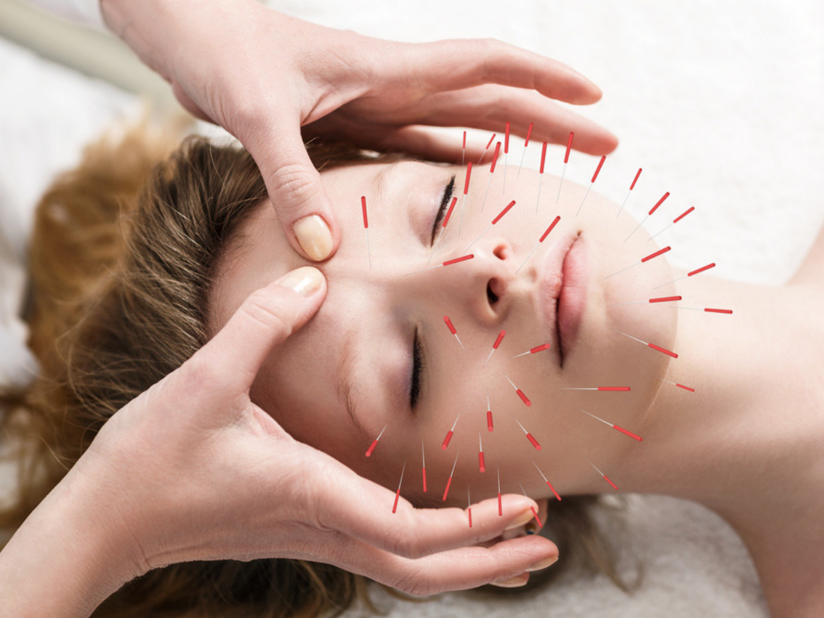 Functioning of Acupuncture