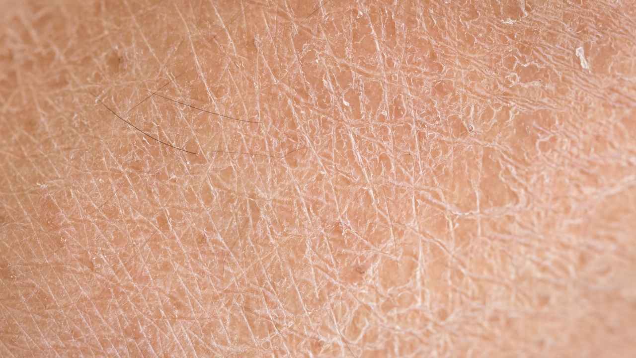 A Closeup of Dry Skin