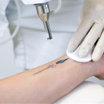 Skin Care Tips After Laser Tatto Removal