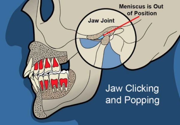 Cracking Or Clicking Sound in the Temporomandibular Joint