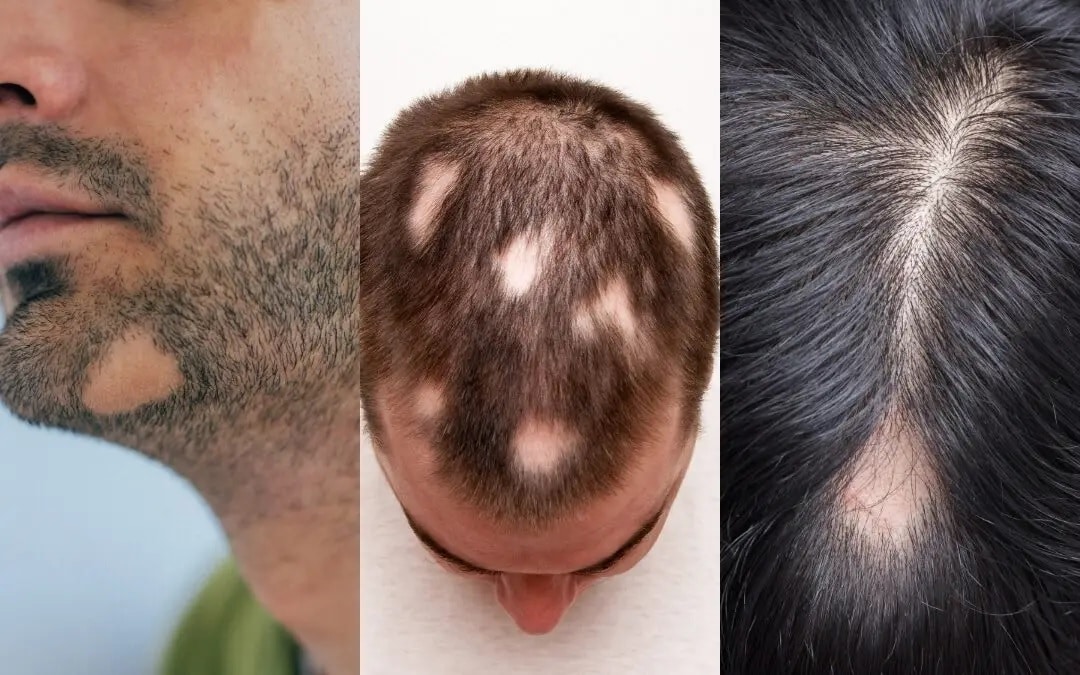 Circular Patches on the Bald